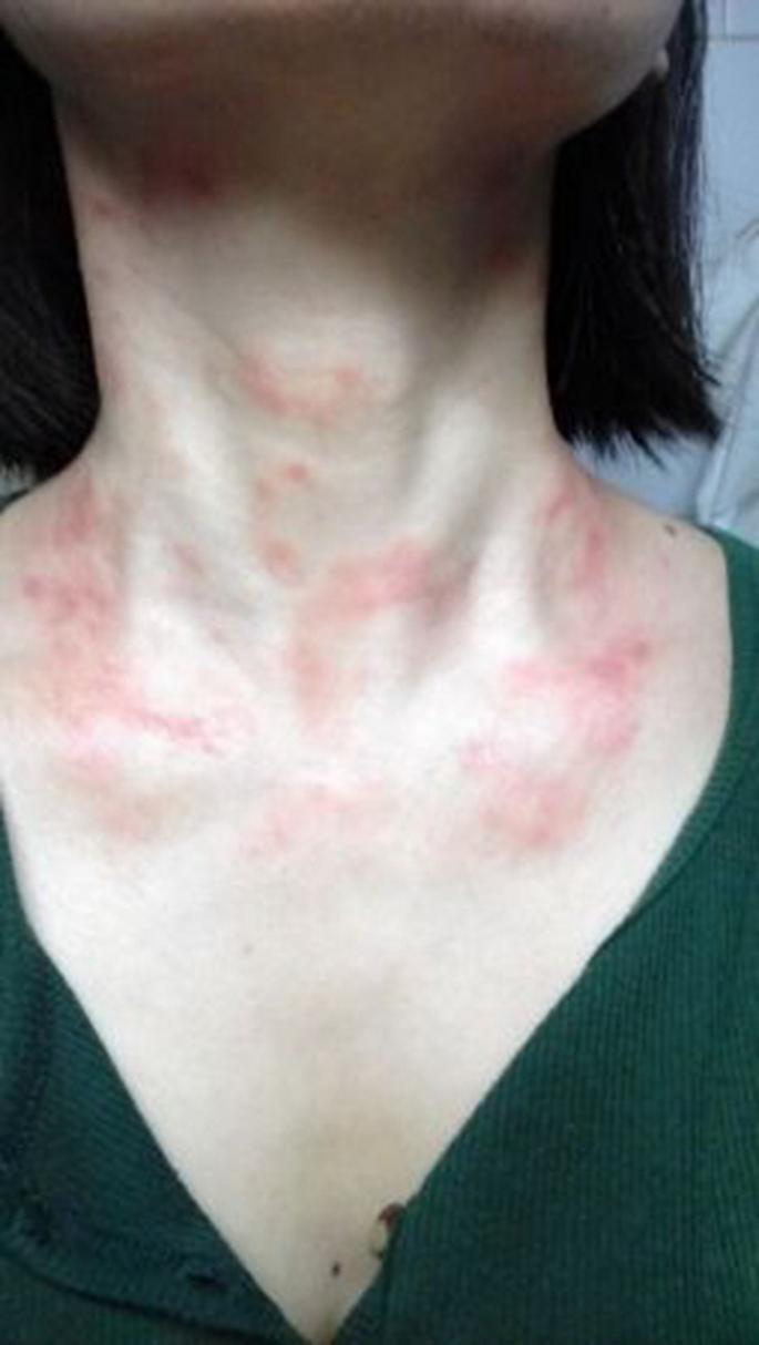 真菌性皮肤病,指的是真菌感染皮肤黏膜引起的疾病.