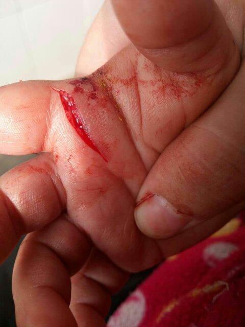 伤口很深,直接去诊所缝合,现在伤口早已痊愈,手指却一直伸直敲着不能