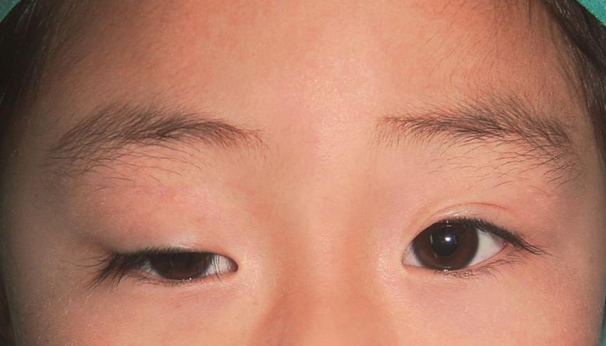上睑下垂是指上眼睑呈现部分或全部下垂,轻者遮盖部分瞳孔,严重者瞳孔