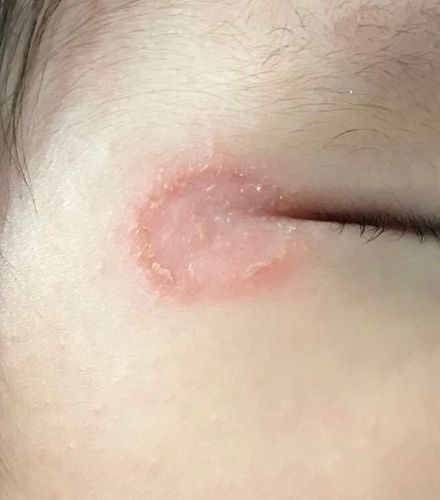 两个月婴儿,脸上长了一圈癣疹,怎处理好