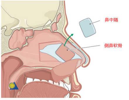 鼻中隔在鼻综合整形# 手术中的优势