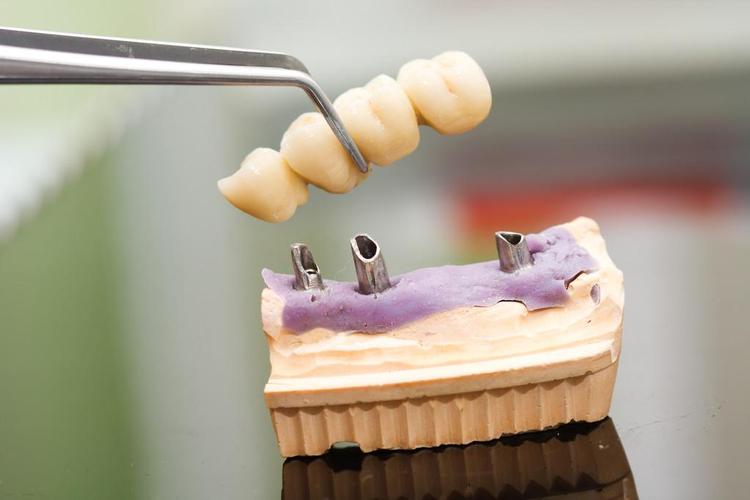 种植牙头和桥,将固定局部义齿 (牙桥) 放在植入物的牙科技师.