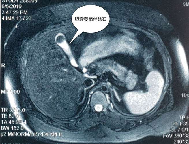 术前核磁片可见:胆囊萎缩伴结石形成;平素经常伴"腹痛"等症状,入院前