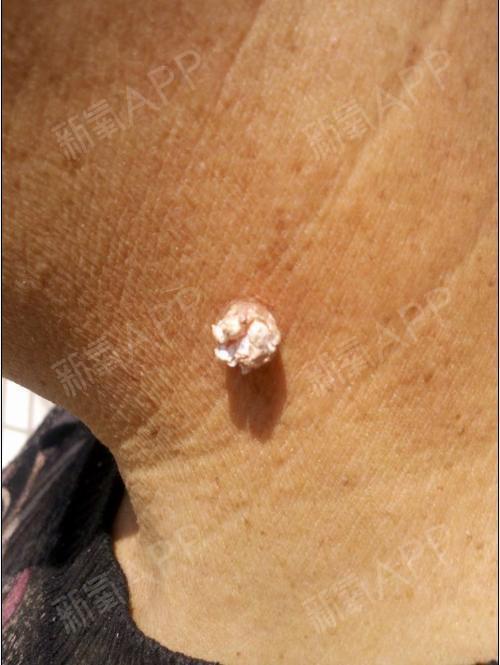 疣是由人类乳头瘤病毒引起的一种皮肤表面赘生物.