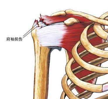 冈上肌肌腱损伤的表现与冈上肌肌腱损伤的治疗
