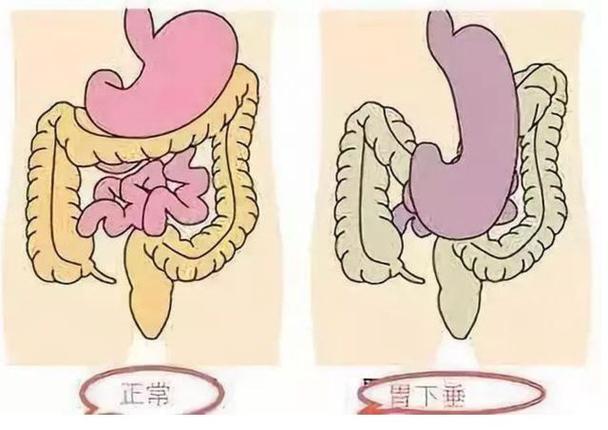 胃下垂的症状和治疗方法有哪些!