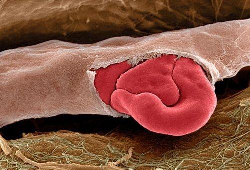 红细胞从破裂的血管中涌出