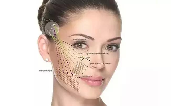 线雕面部提拉技术,通过线雕提升脸部,非手术埋线技术,不开刀,不缝合