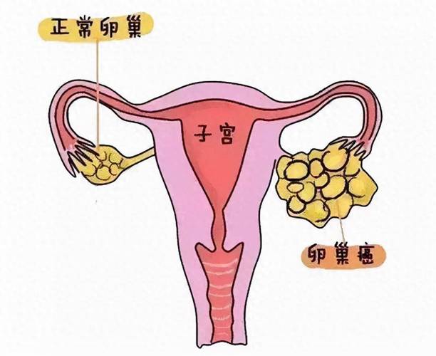 卵巢癌,这一名字可能在健康话题中不如乳腺癌或子宫颈癌那般频繁被