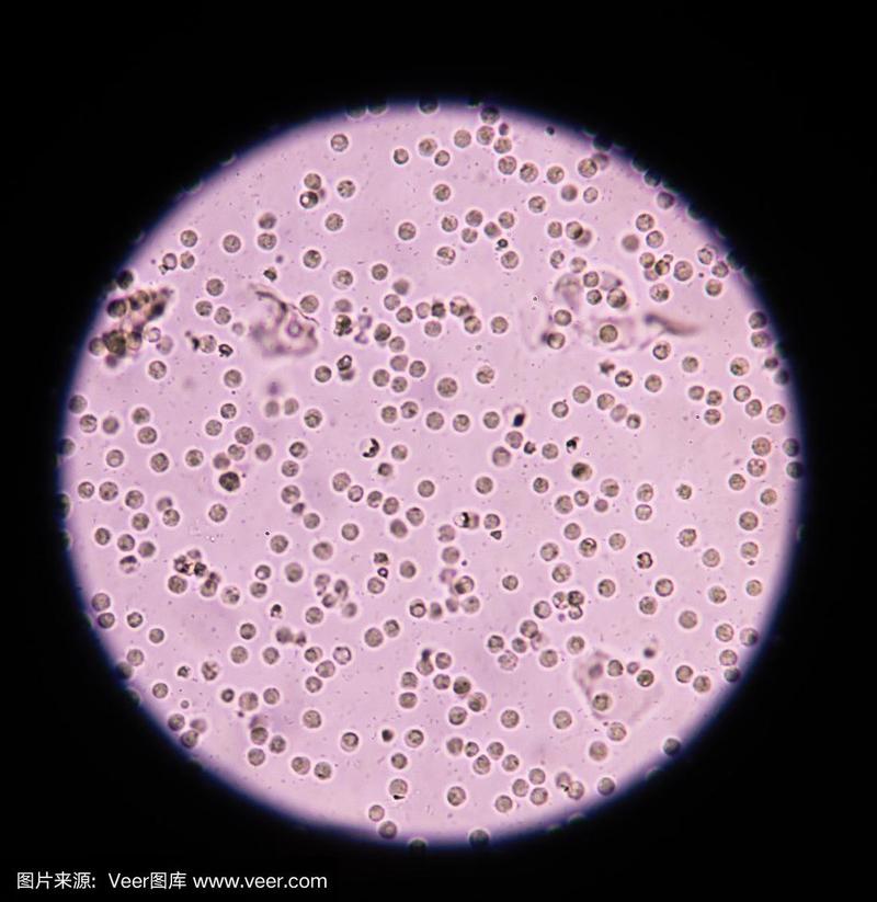 400倍显微镜下尿液标本的白细胞.