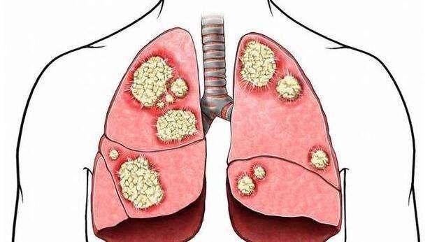 肺癌早期手术后能彻底治愈吗