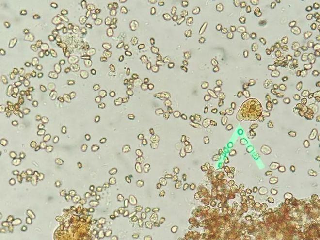 取标本生理盐水制片,镜下可见大量红细胞,其间夹杂着白细胞和一些类