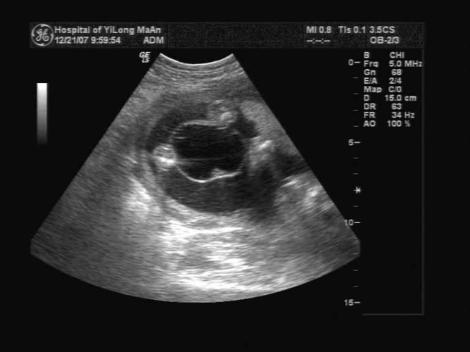产前超声诊断宫内胎儿脐膨出1例及文献复习答案
