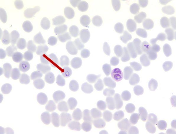 其它 2018年细胞形态学培训考试 a:疟原虫环状体 b: 卡波环 c: 豪周小