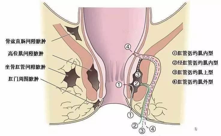 主要症状是肛周局部隆起肿块,常伴有红,肿,热,痛等症状,少数伴有全身