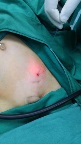 曲靖市二院在云南省地市级医院率先开展微型腹腔镜手术治疗小儿疝气