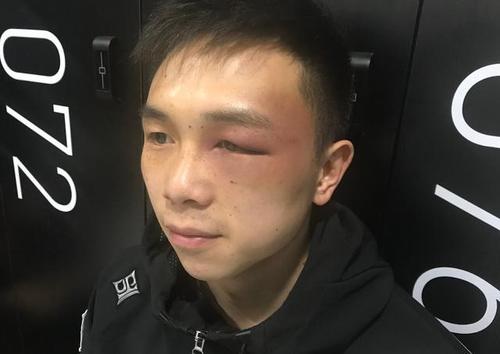 属的m23拳击战队上传了徐灿红肿部位的照片,m23写到:"徐灿受伤处特写