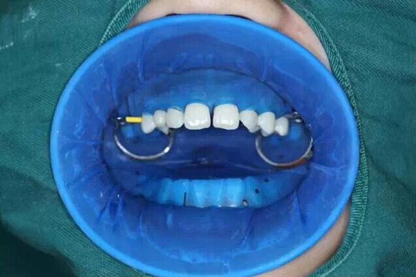 橡皮障在现代牙科中的应用