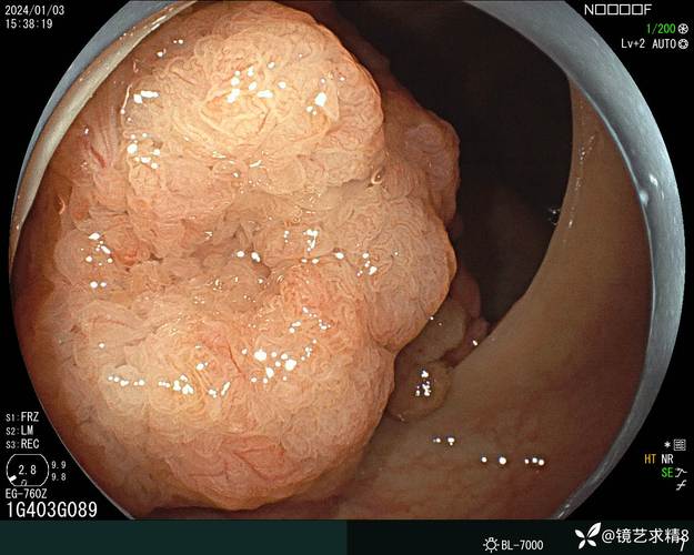 直肠巨大管状绒毛状腺瘤1例