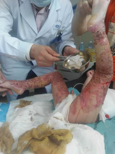 两岁的儿子姚思齐在3月19日在家玩耍不慎跌入滚烫的猪食锅中烫伤严重