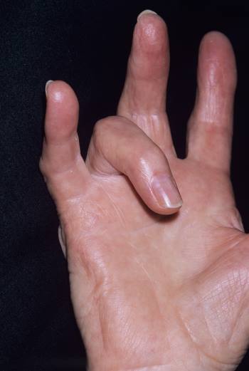 肌肉骨骼及结缔组织疾病 手部疾病  手指屈肌腱炎和腱鞘炎(扳机指)