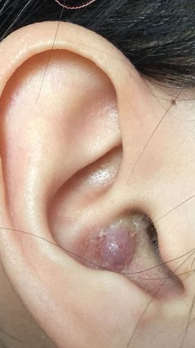 耳朵内长这样的痘痘是什么原因?