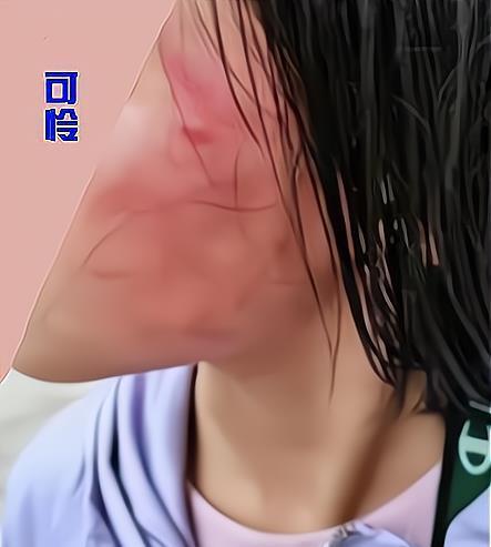 广西玉林7岁女童被同一小区玩伴妈妈连扇数耳光致脸肿胀鼻出血