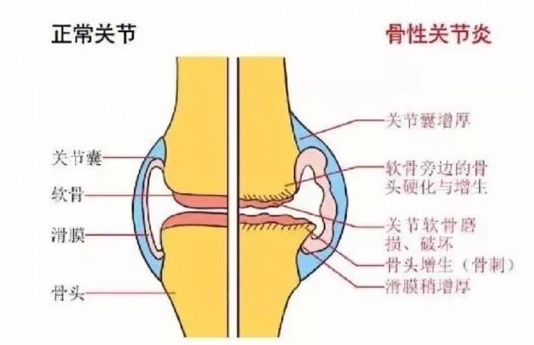 冬天膝关节受凉导致的疼痛