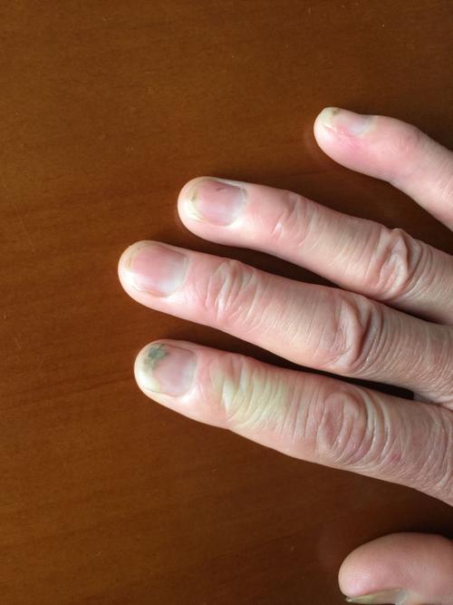手指甲,这是灰指甲么? 每年5月份到10月份,指甲往里面长.