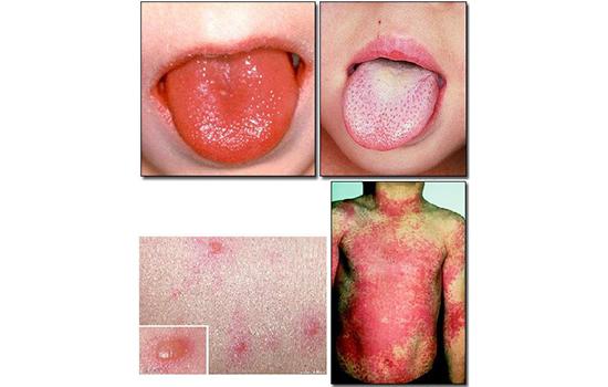 猩红热是一种急性呼吸道传染病,中医称之为"烂喉痧",这种病一年四季都
