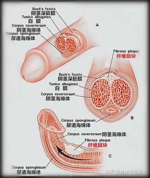临床特点为阴茎弯曲畸形的稳定和勃起疼痛的消失,病理学特征为成熟