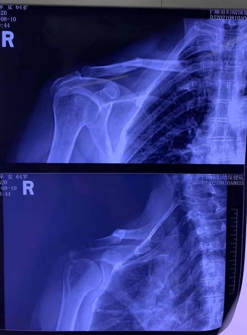 十堰市妇幼保健院成功开展锁骨骨折切开复位钢板内固定术
