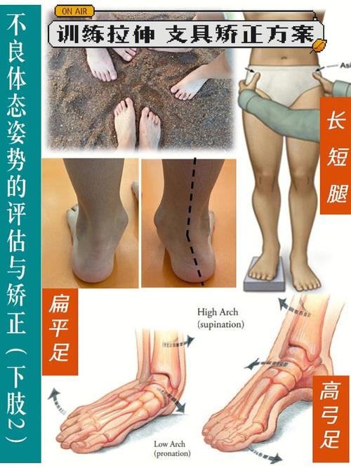 下肢矢状面常见不良形态有高弓足,扁平足,长短腿等.