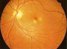 中心性渗出性脉络膜视网膜病变