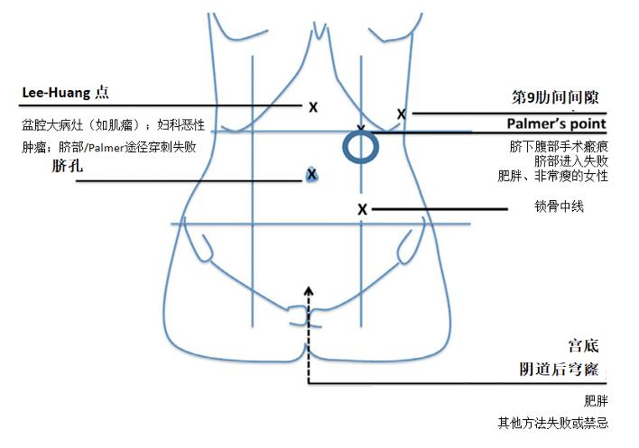 前腹壁和 veress 针穿刺部位的解剖表 2.