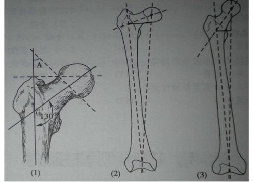 x 线测量股骨颈前倾角这个新方法简单又可靠-丁香园