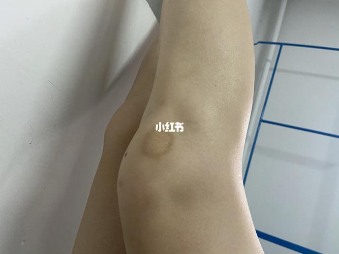 膝盖上有个那么大的疤怎么办0101