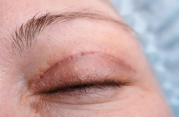刚做完双眼皮听说后面一个月是疤痕增生期请问怎样才能预防双眼皮术后