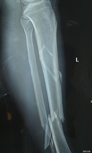 闭合性胫腓骨骨折1月余,足部软组织坏死植皮术合并糖尿病后手术方案的