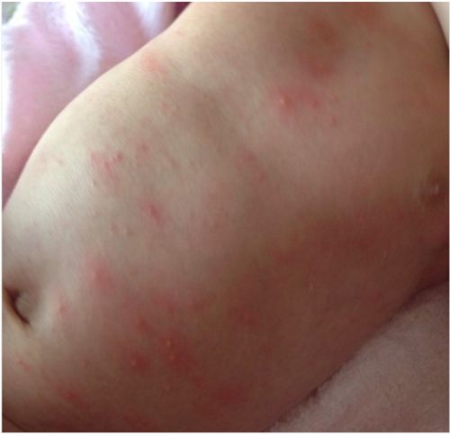 麻疹和幼儿急疹的图片