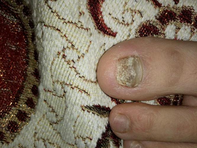 大脚趾灰指甲好几年了,没怎麼管过它,喷过一次药,没什麼效果,自已一直