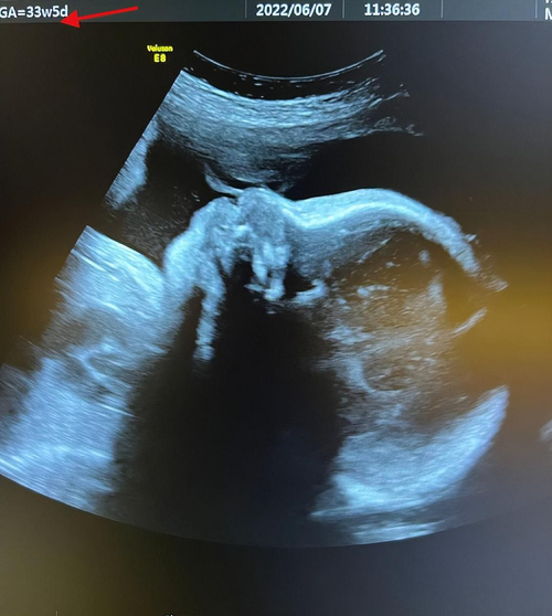 从超声波照片上看,6月7日产检的陈燃,当时已经怀孕33周5天,进入孕