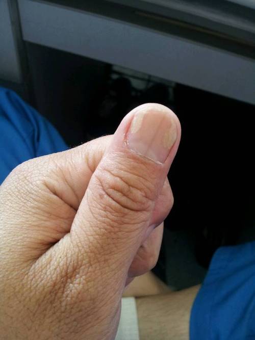 我这手指甲变成这样有好几个手指了,是不是缺钙呀!要紧吗?