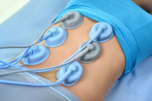 艾利特rt700系列干扰电治疗仪,配合吸附电极碗,交叉附于腰部疼痛区域.