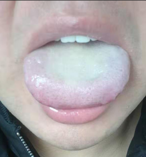 舌诊哥23岁车手失眠舌诊分析案例肝郁气滞脾虚舌象