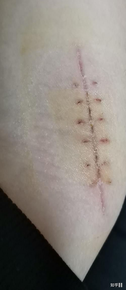 伤口被缝针是一种什么样的体验?