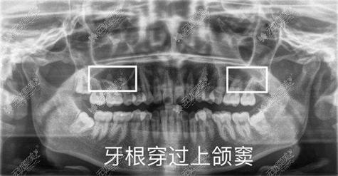 上颌骨牙根的位置