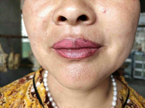 唇部后期发黑的原因及治疗的方法