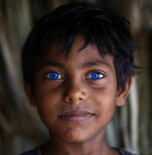 男孩长异鬼瞳孔 瞳孔呈现蓝颜色