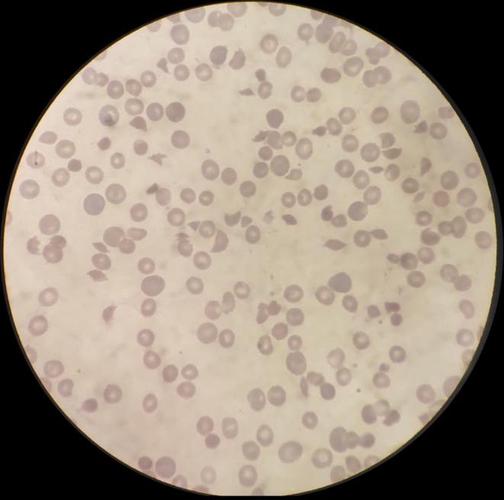 网织红21.65%,rbc报警提示有红细胞碎片.